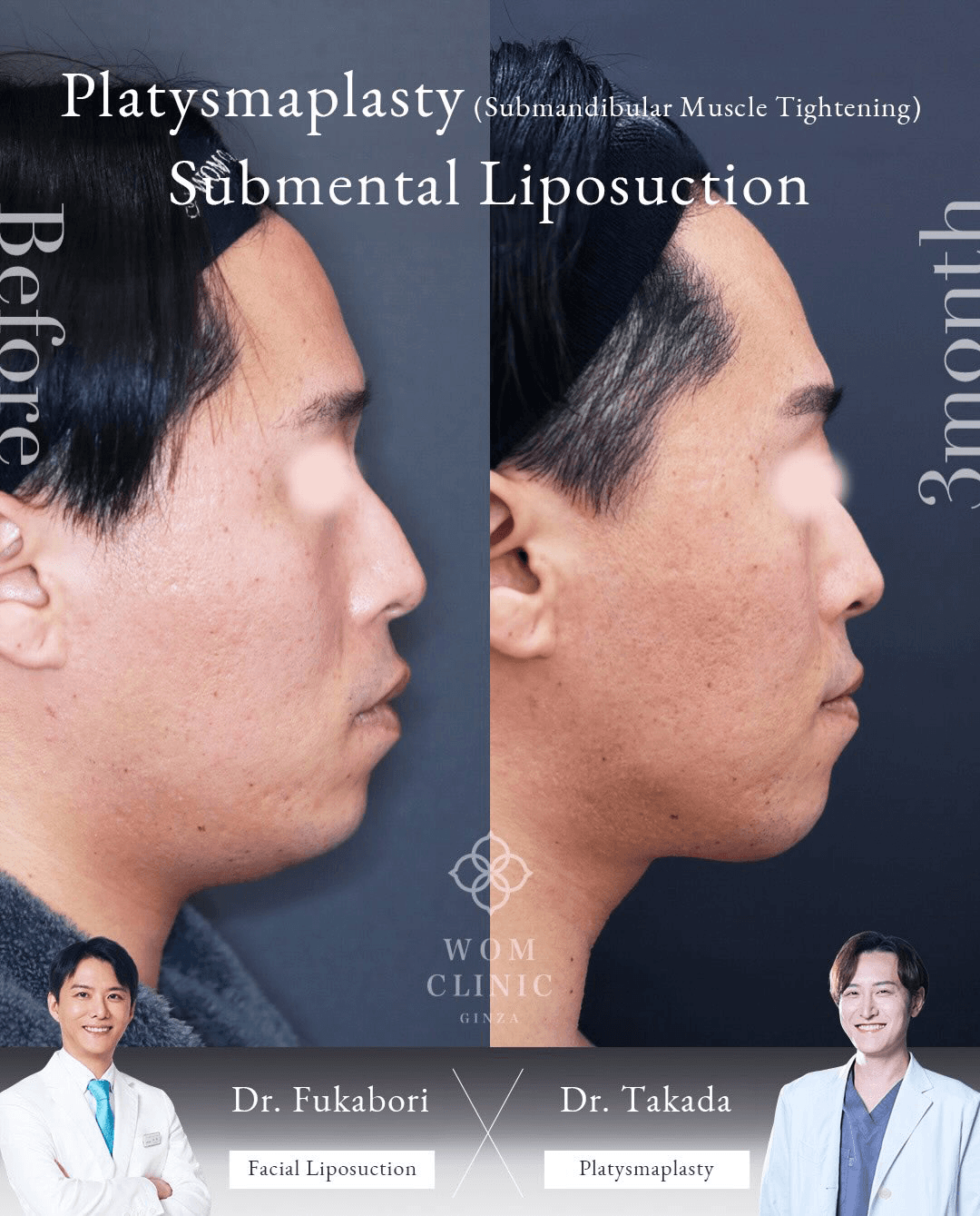 Before-and-after comparison of submental liposuction and platysmaplasty